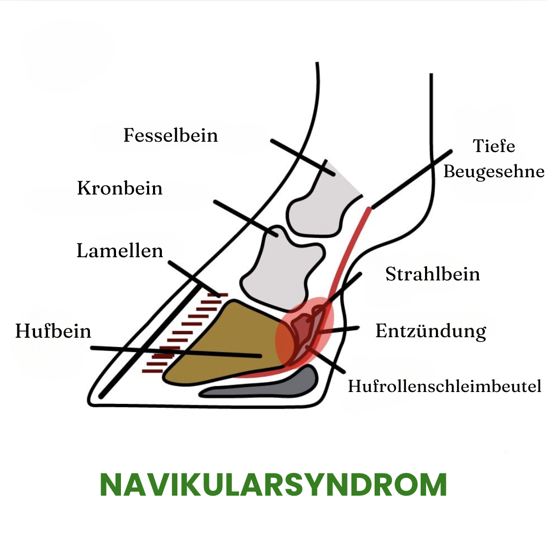 Schéma du syndrome naviculaire